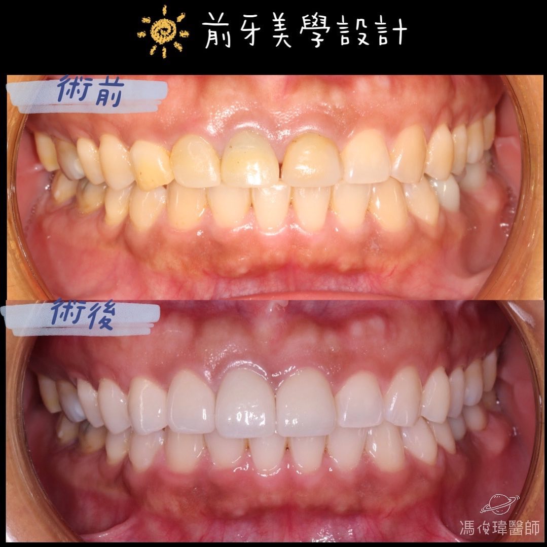 前牙美學+全口美白 前牙美學+全口美白