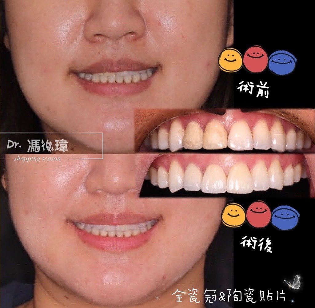 前牙美學:案例二 前牙美學:案例二