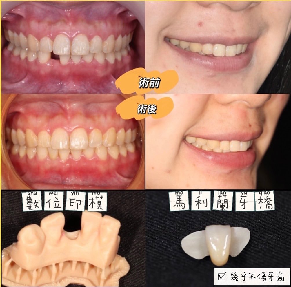 前牙美學:案例一 前牙美學:案例一