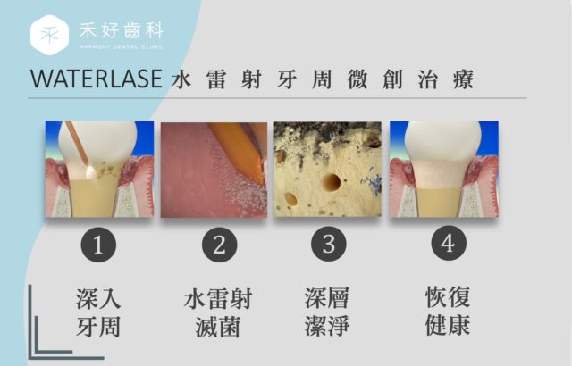 水雷射牙周微創治療