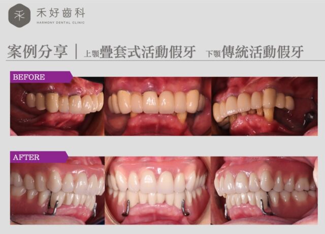 禾好齒科 案例分享 上顎疊套式活動假牙 下顎傳統活動假牙