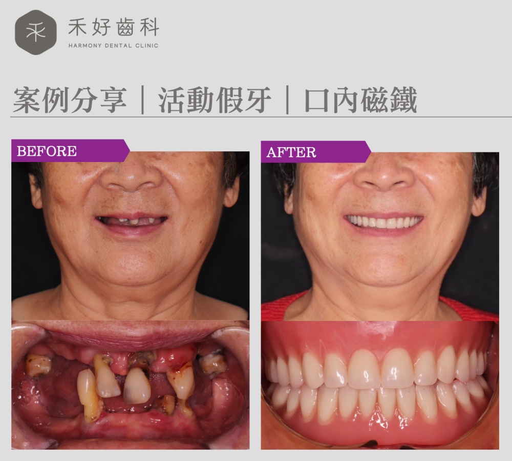 禾好齒科 案例分享 活動假牙 口內磁鐵 禾好齒科 案例分享 活動假牙 口內磁鐵