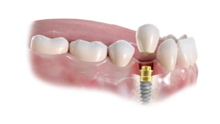 https://new.harmonydc.com.tw/wp-content/uploads/2025/07/teeth-01.jpg