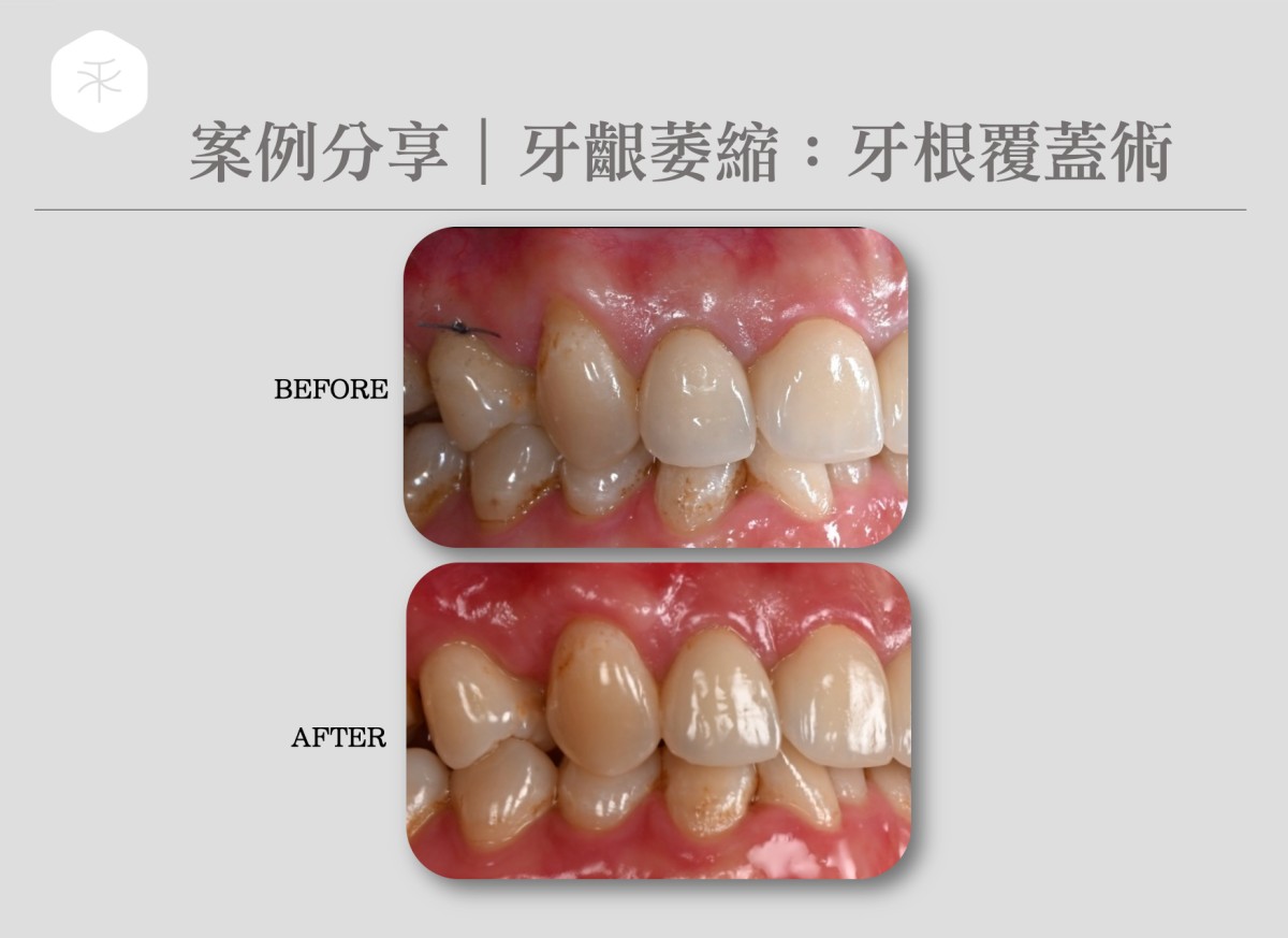 牙根覆蓋術1