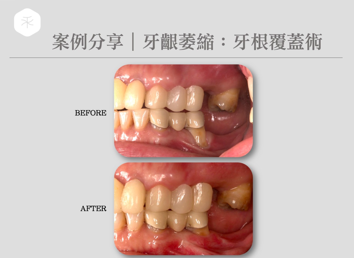 牙根覆蓋術